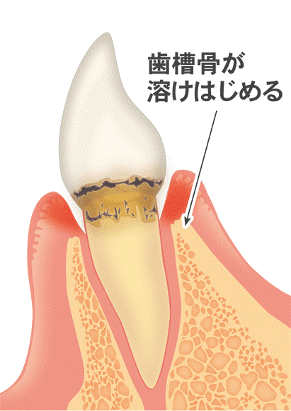 歯周病01